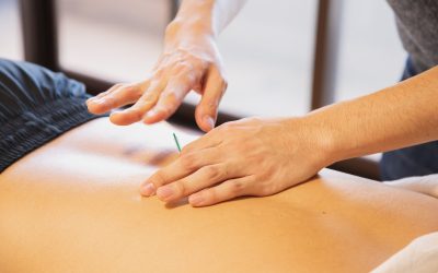 As diferenças entre Dry Needling vs. Acupuntura – qual escolher?