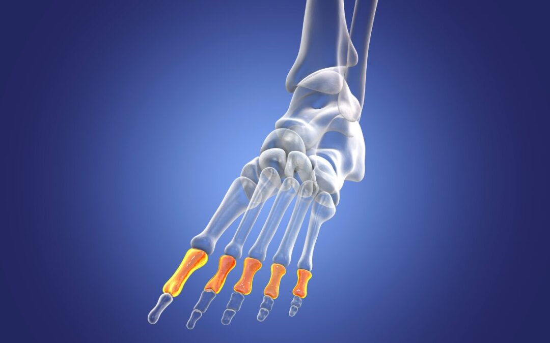 Neuroma de Morton