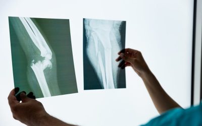 Fisioterapia para Traumatologia Ortopédica em Pinheiros
